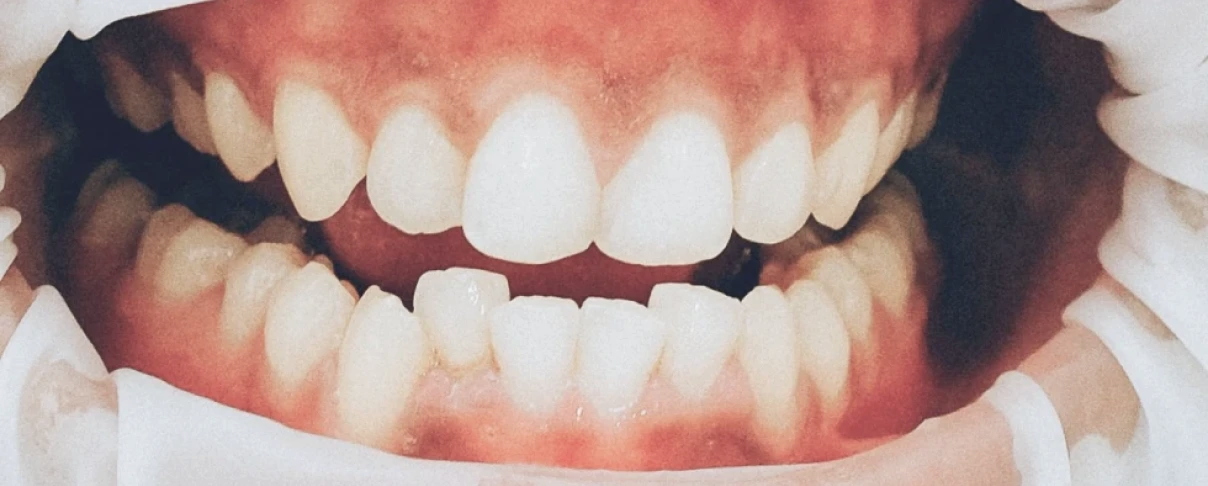 Malocclusion dentaire